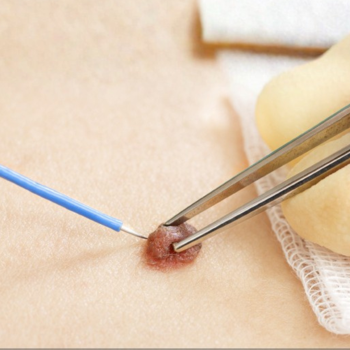 Proderma, piel, biopsia,  dermatología