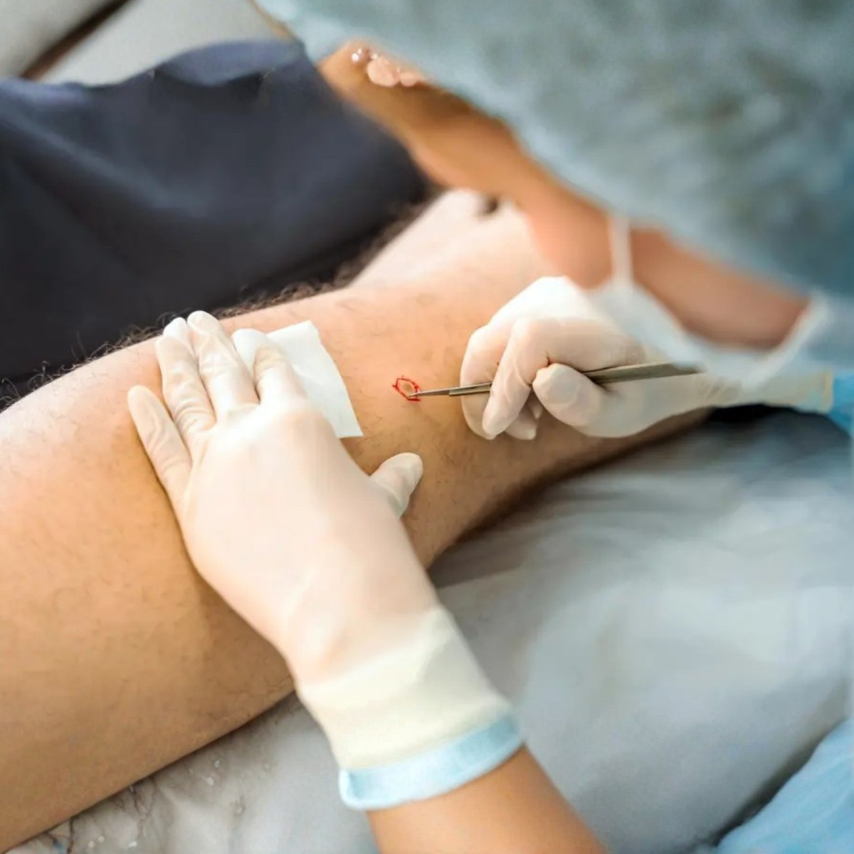 Proderma, cirugía,  mohs, dermatología,  Oncoquirúrgica 