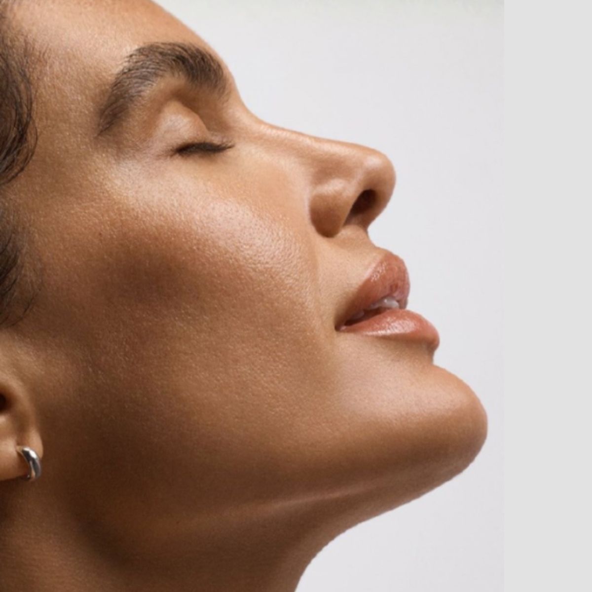 Proderma, dermatología,  clínica,  mentón, papada