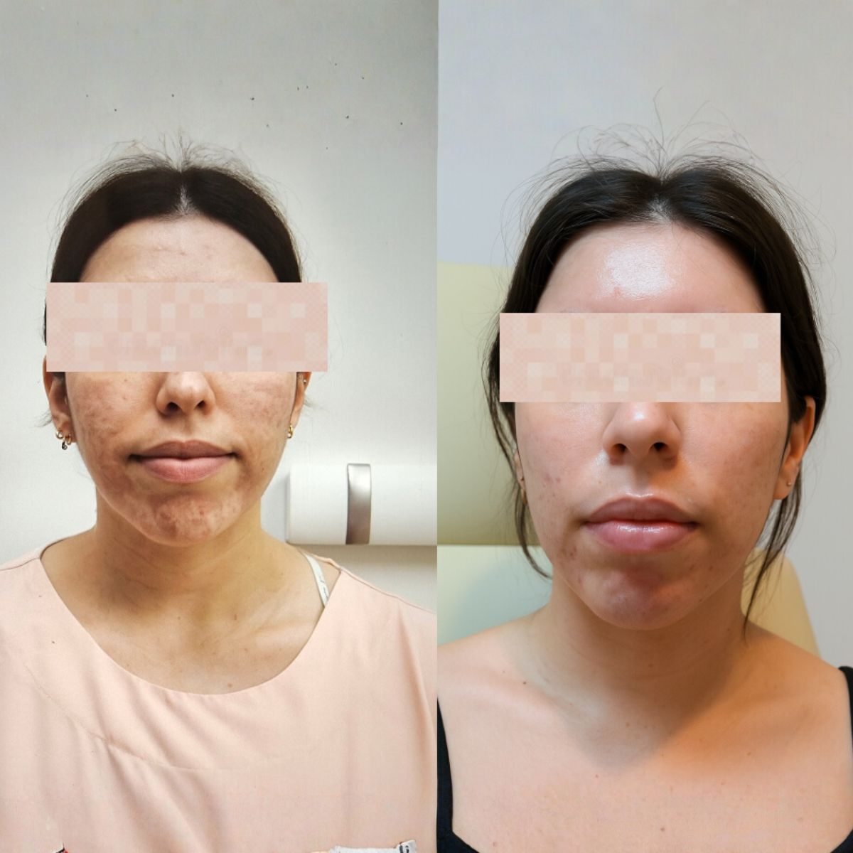 Proderma,  dermatología,  clínica, arrugas, rejuvenecimiento,  cicatrices,  acné 