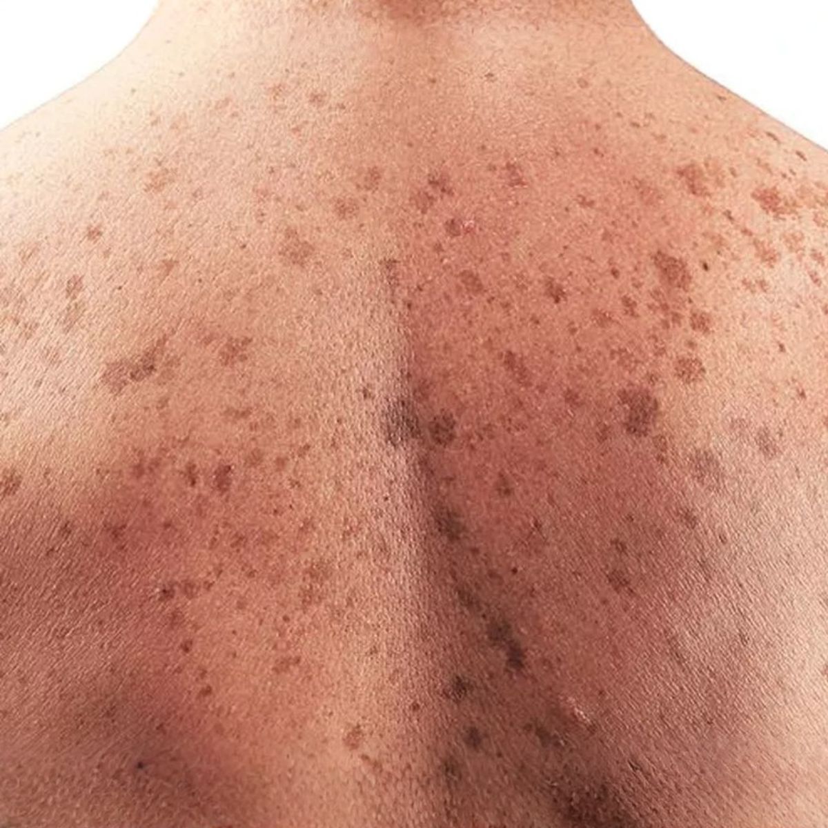 Proderma,  dermatología,  cáncer, precancer, vph