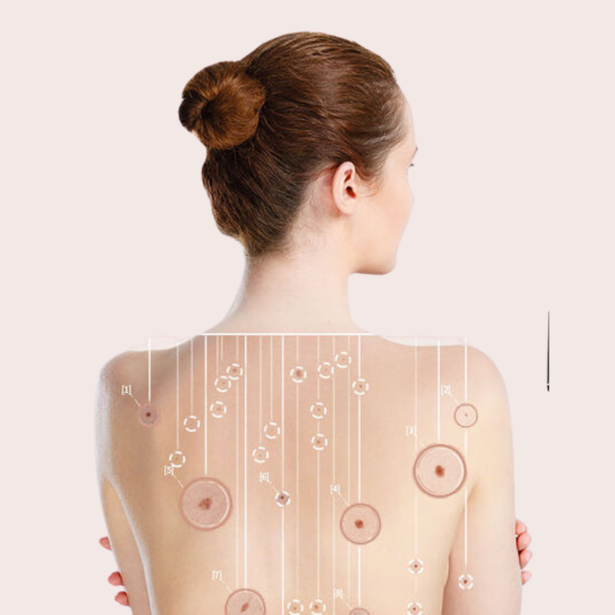 Proderma, lunares, piel, cáncer, clínica