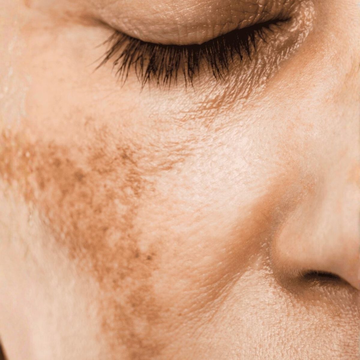 Melasma