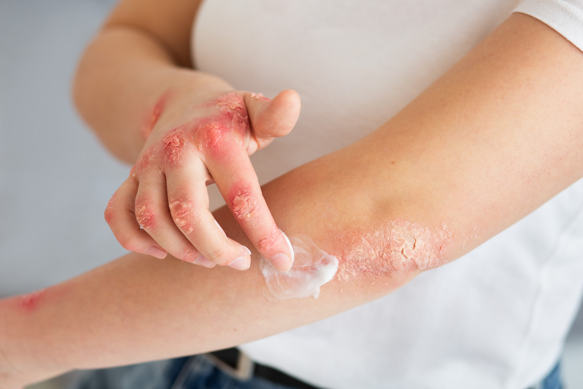 Proderma, dermatología, clínica, piel irritada, psoriasis