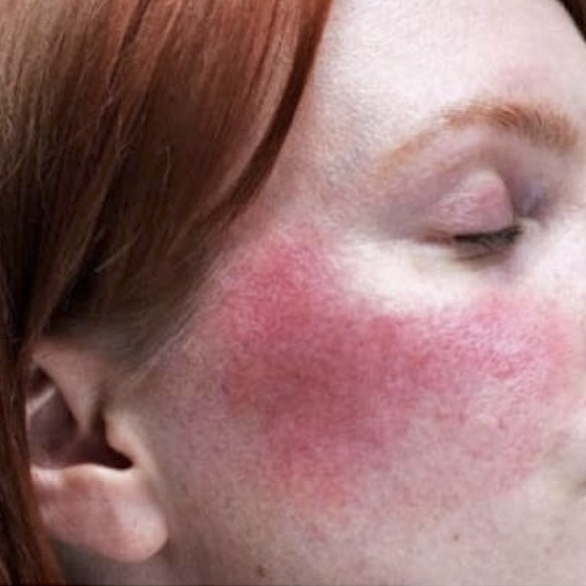 Rosacea