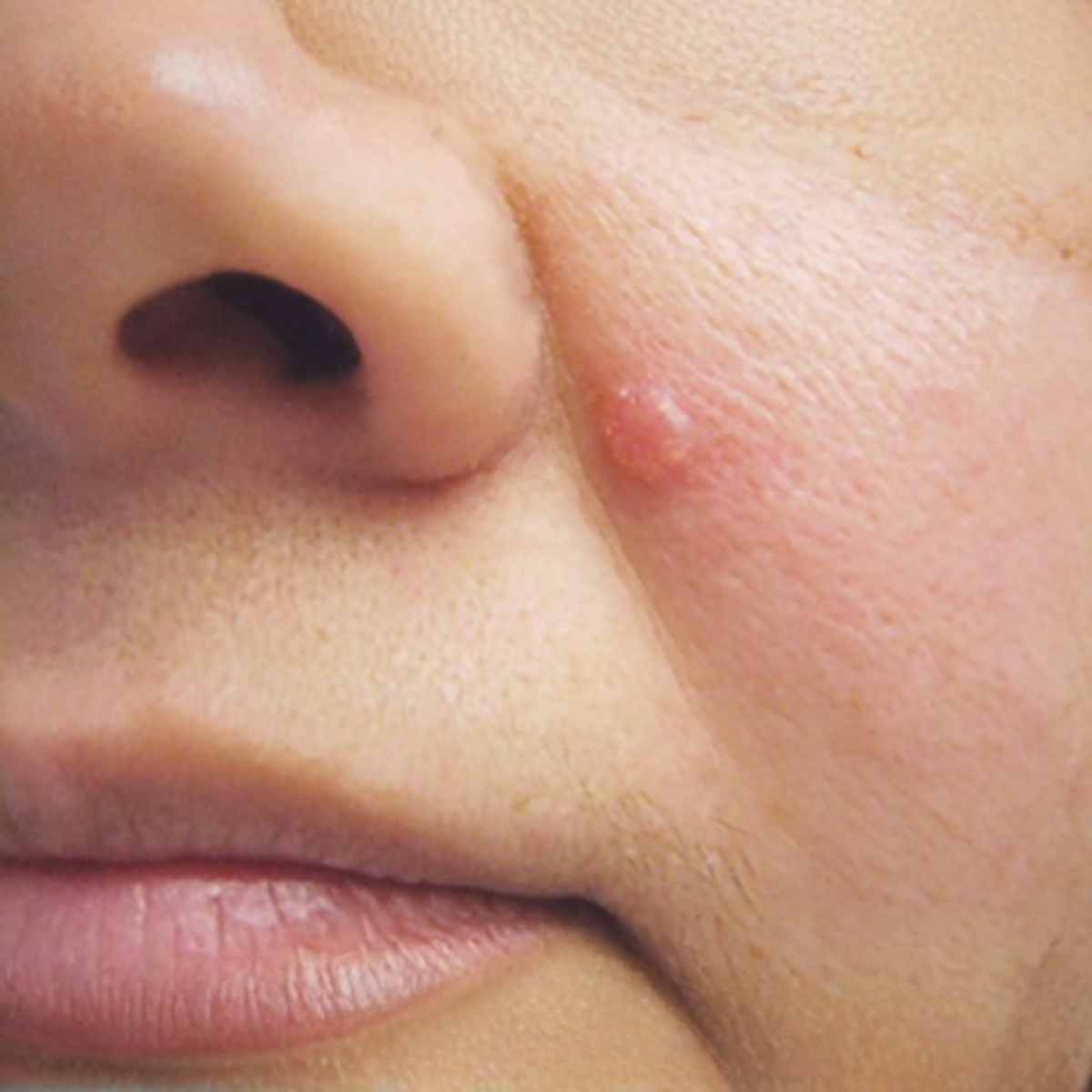 Proderma,  dermatología,  clínica, tumor, carcinoma basocelular 