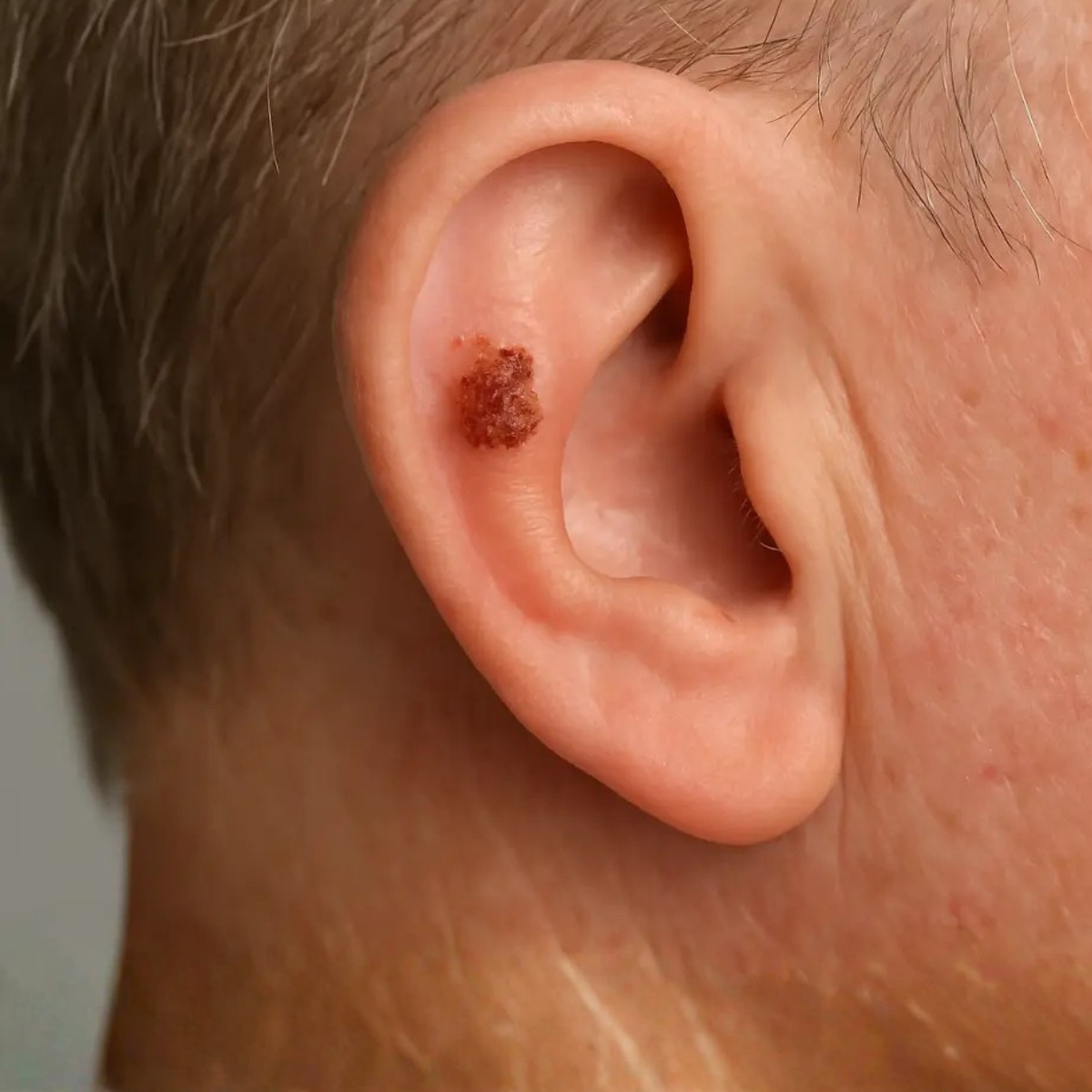 Proderma, dermatología,  cáncer, carcinoma espinocelular, clínica,  tumor