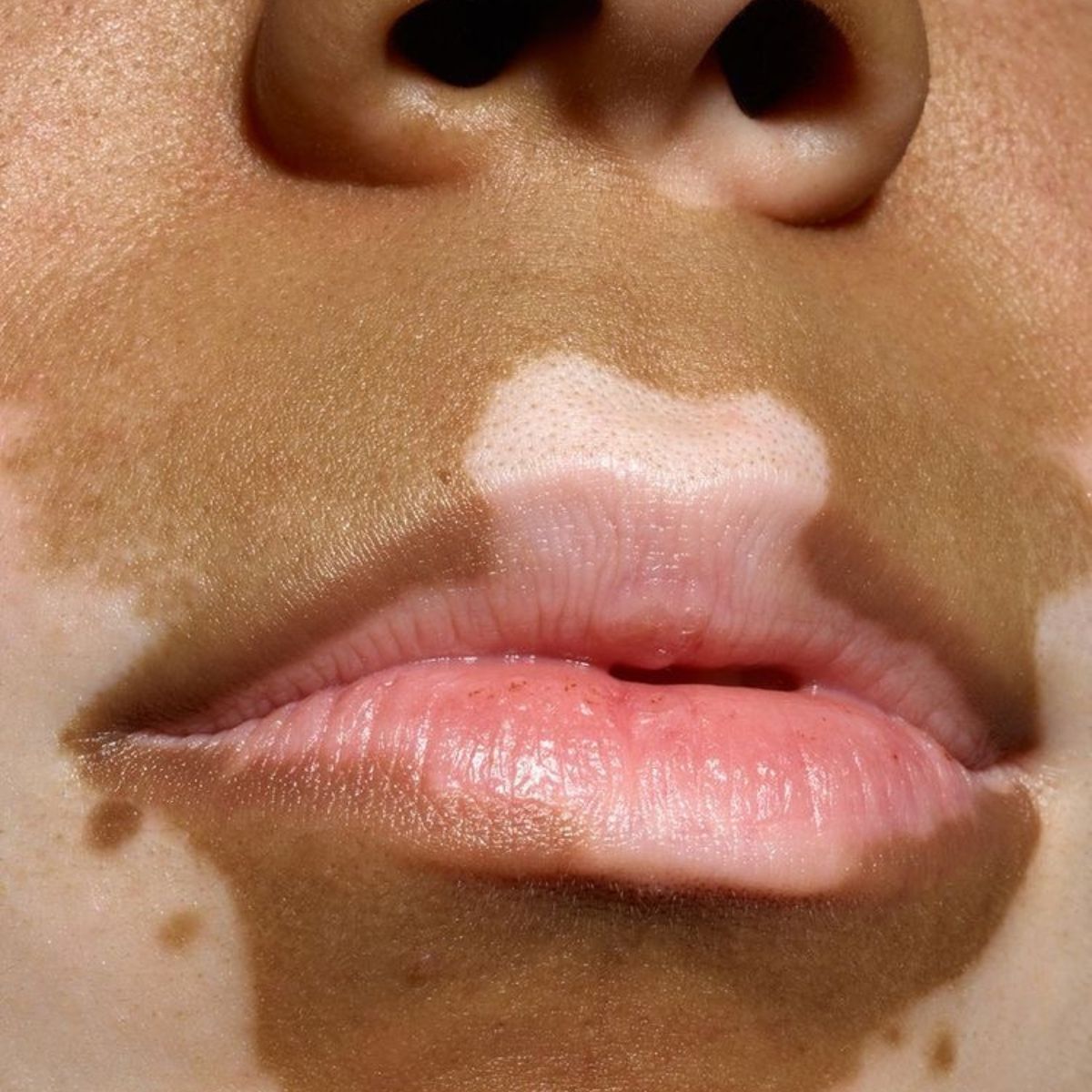 Proderma, dermatología, vitiligio, piel